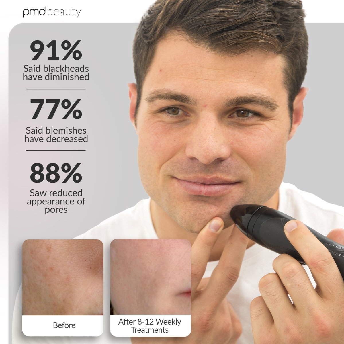 pmd-beauty-personal-microderm-pro-black-professional-at-home-microdermabrasion-w image 4