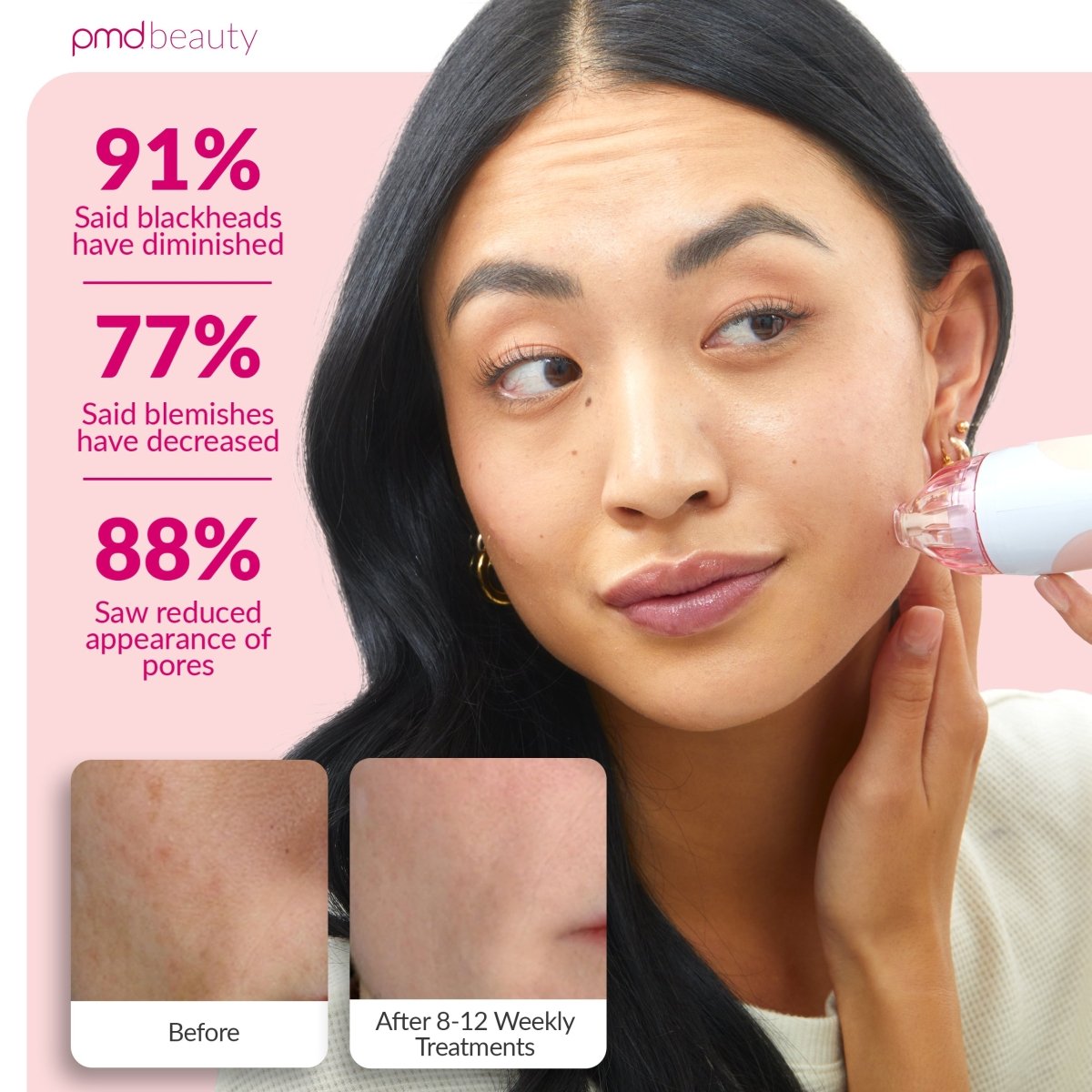 pmd-beauty-personal-microderm-classic-at-home-microdermabrasion-device-with-pate image 4
