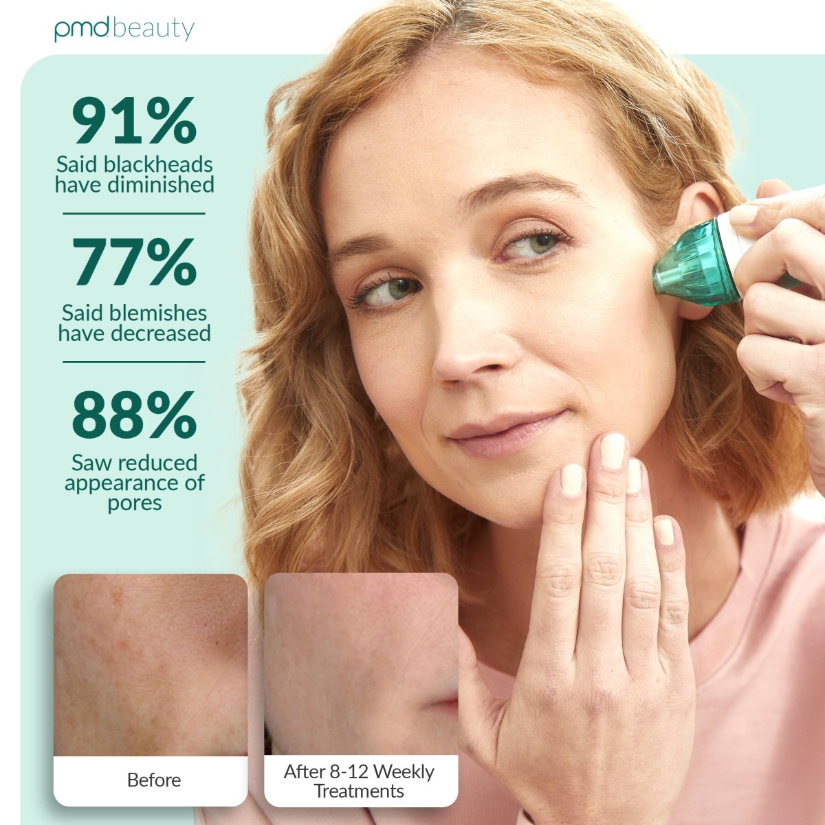 pmd-beauty-personal-microderm-classic-international-version-at-home-microdermabr image 4