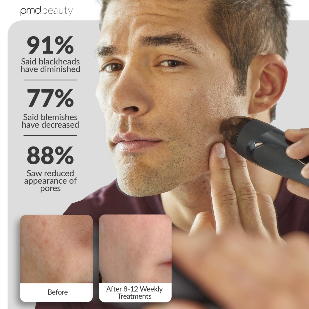 pmd-beauty-personal-microderm-elite-pro-black-advanced-at-home-microdermabrasion image 4