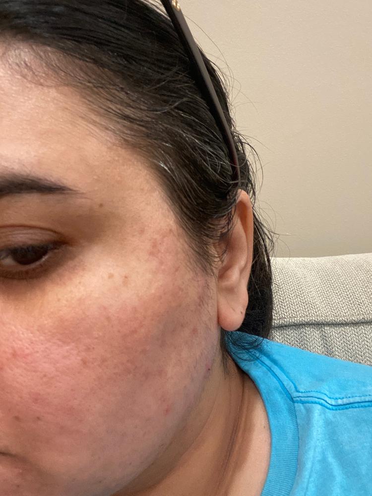 Okay, but not for severe acne
