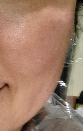 Works on dark spots!