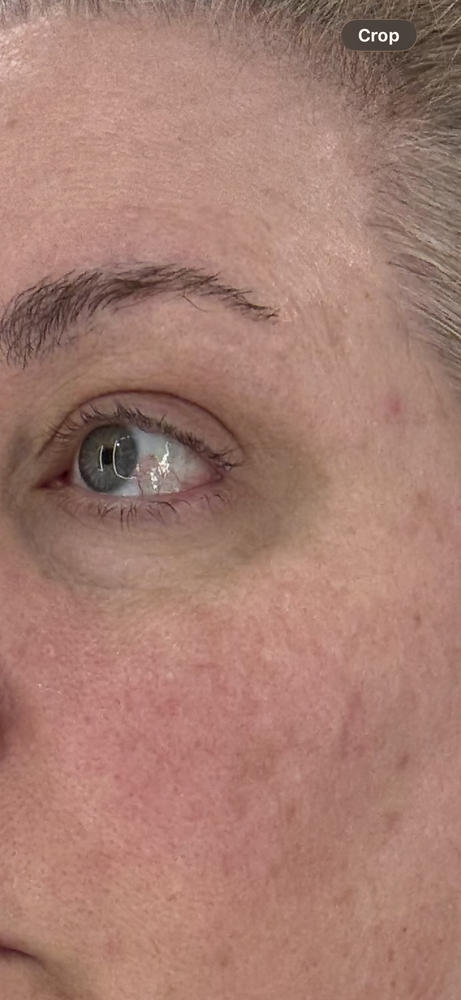 Helped my dark circles