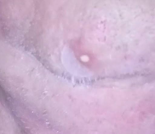 Good for small zits