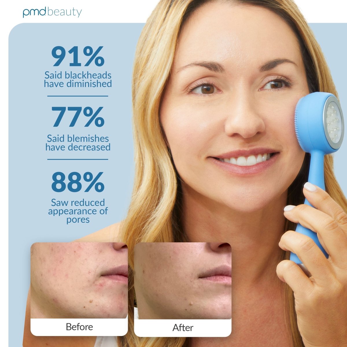 pmd-beauty-led-clean-acne-man-blue-light-therapy-sonic-cleansing-device image 4