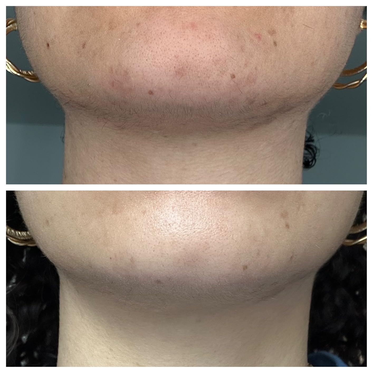 Great for post-acne marks