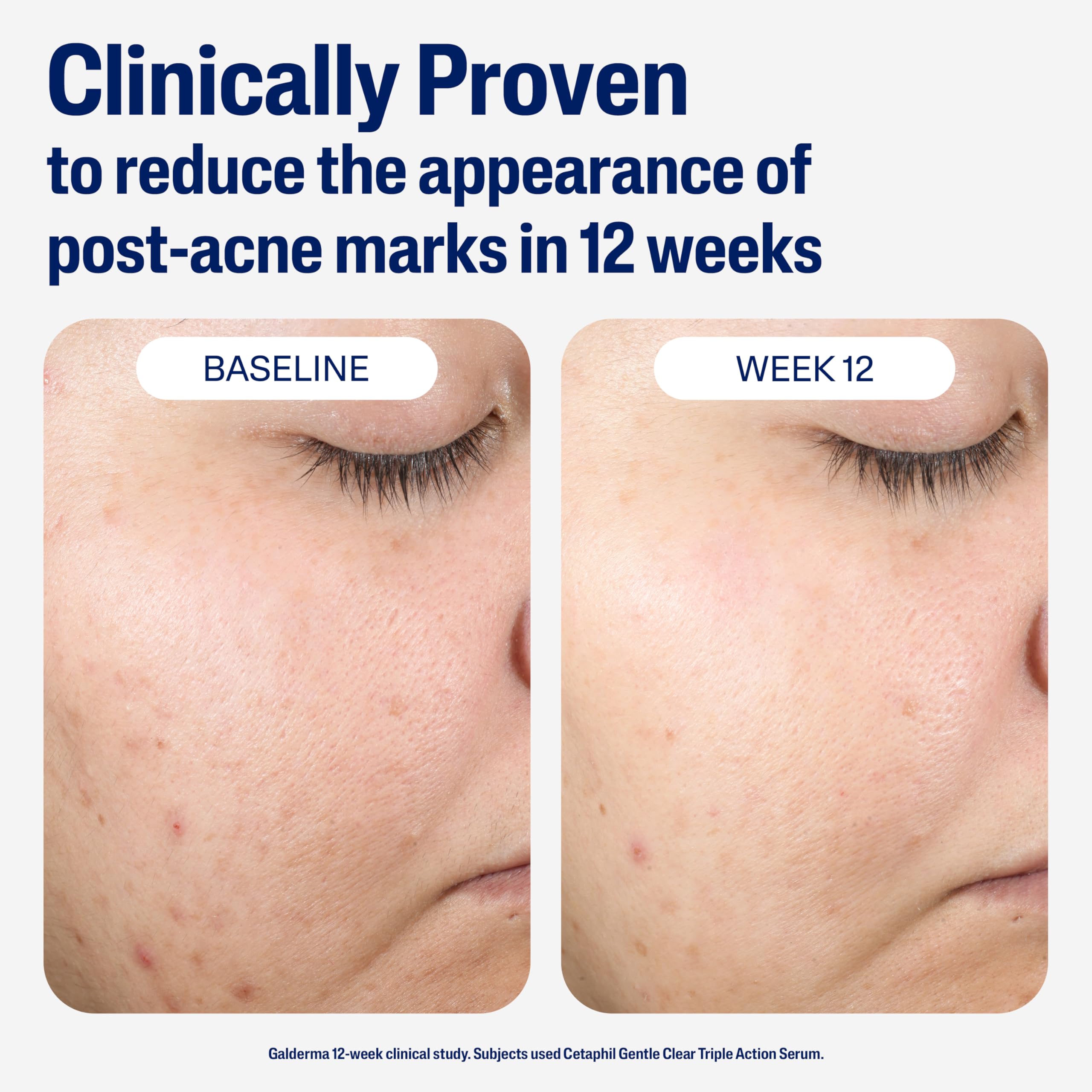 cetaphil-gentle-clear-repairing-post-acne-serum-1-oz-retinol-alternative-with-ba image 5