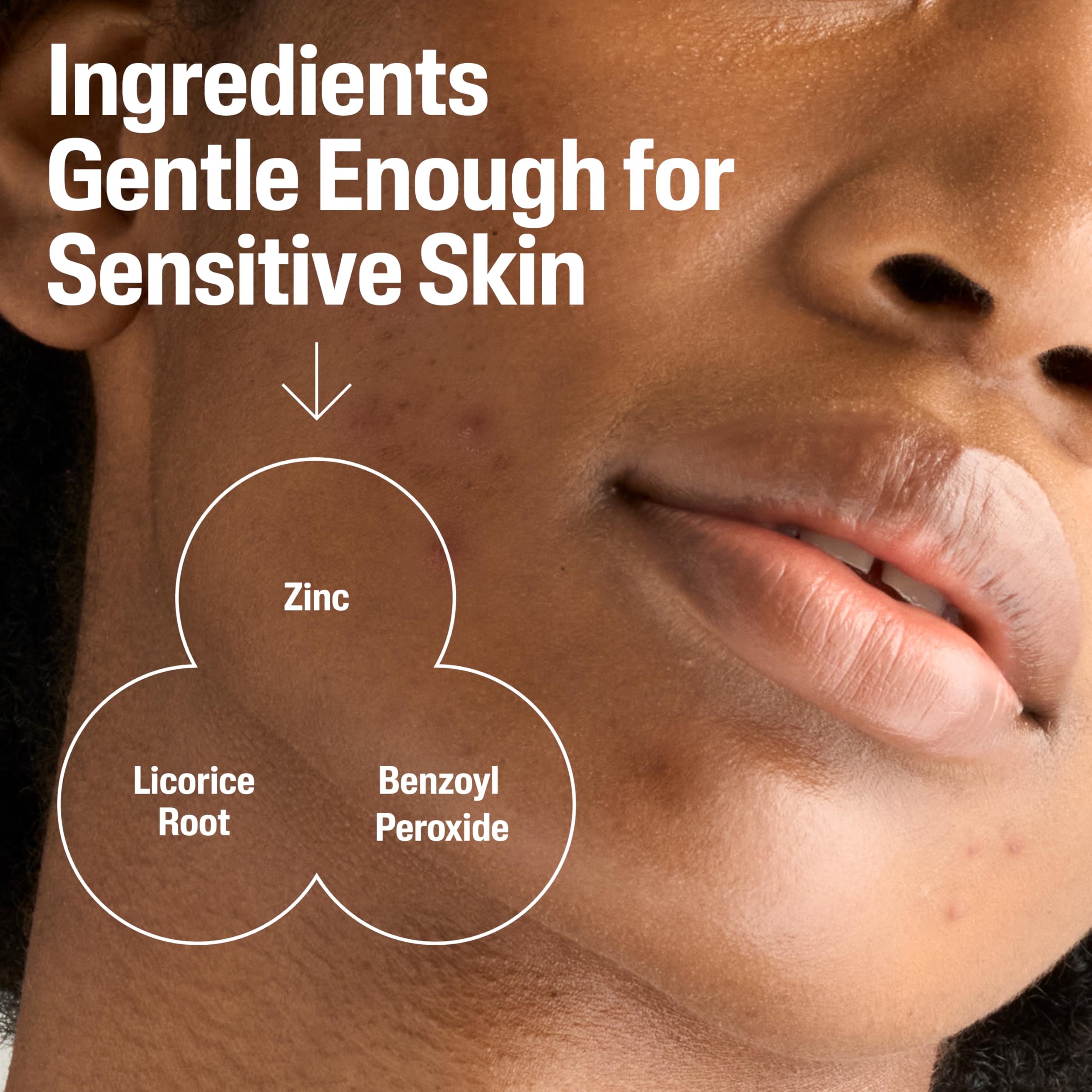 cetaphil-gentle-clear-complexion-clearing-bpo-acne-cleanser-2-6-benzoyl-peroxide image 5