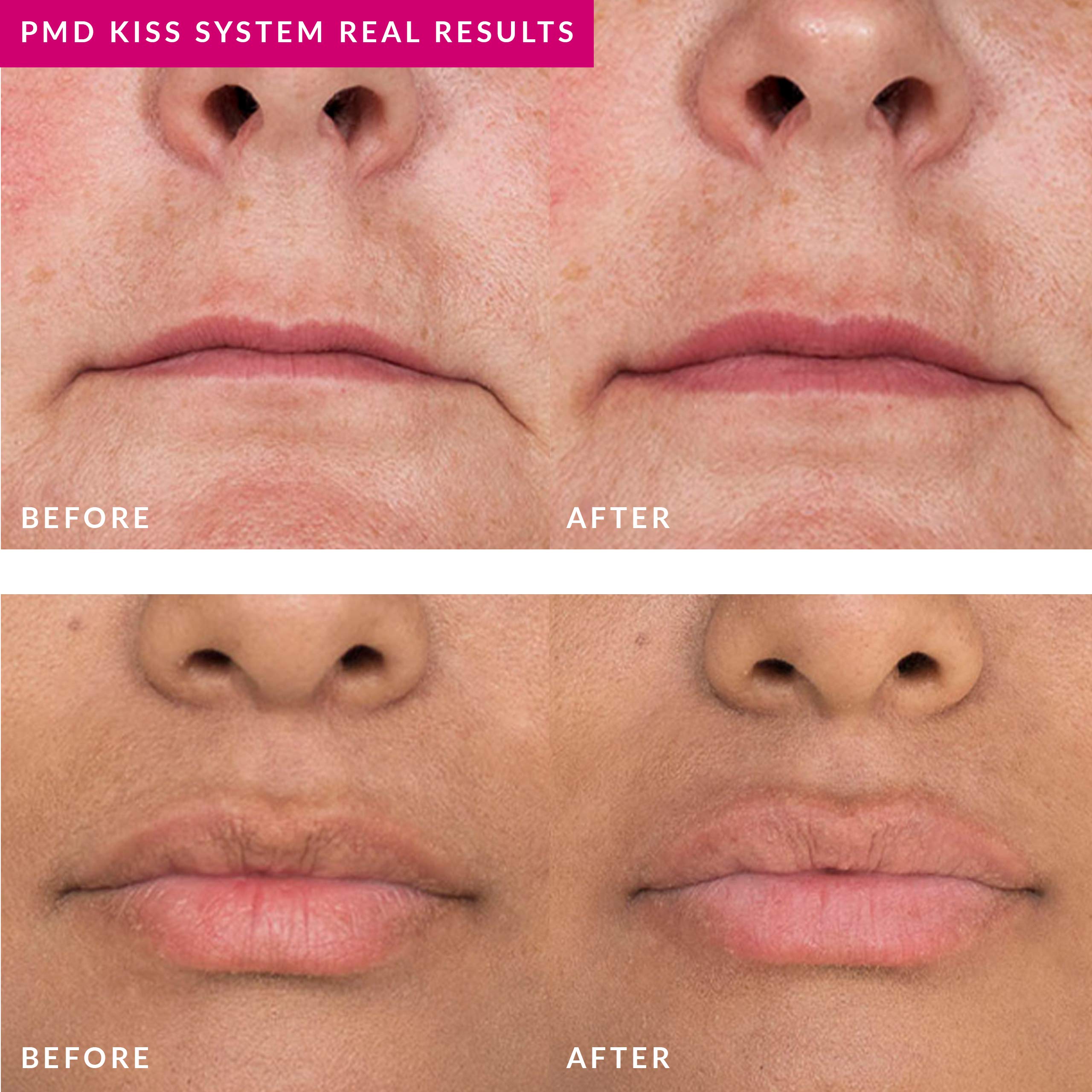pmd-smart-lip-plumping-serum-10-ml-with-hyaluronic-acid-and-hydrapeptides image 5