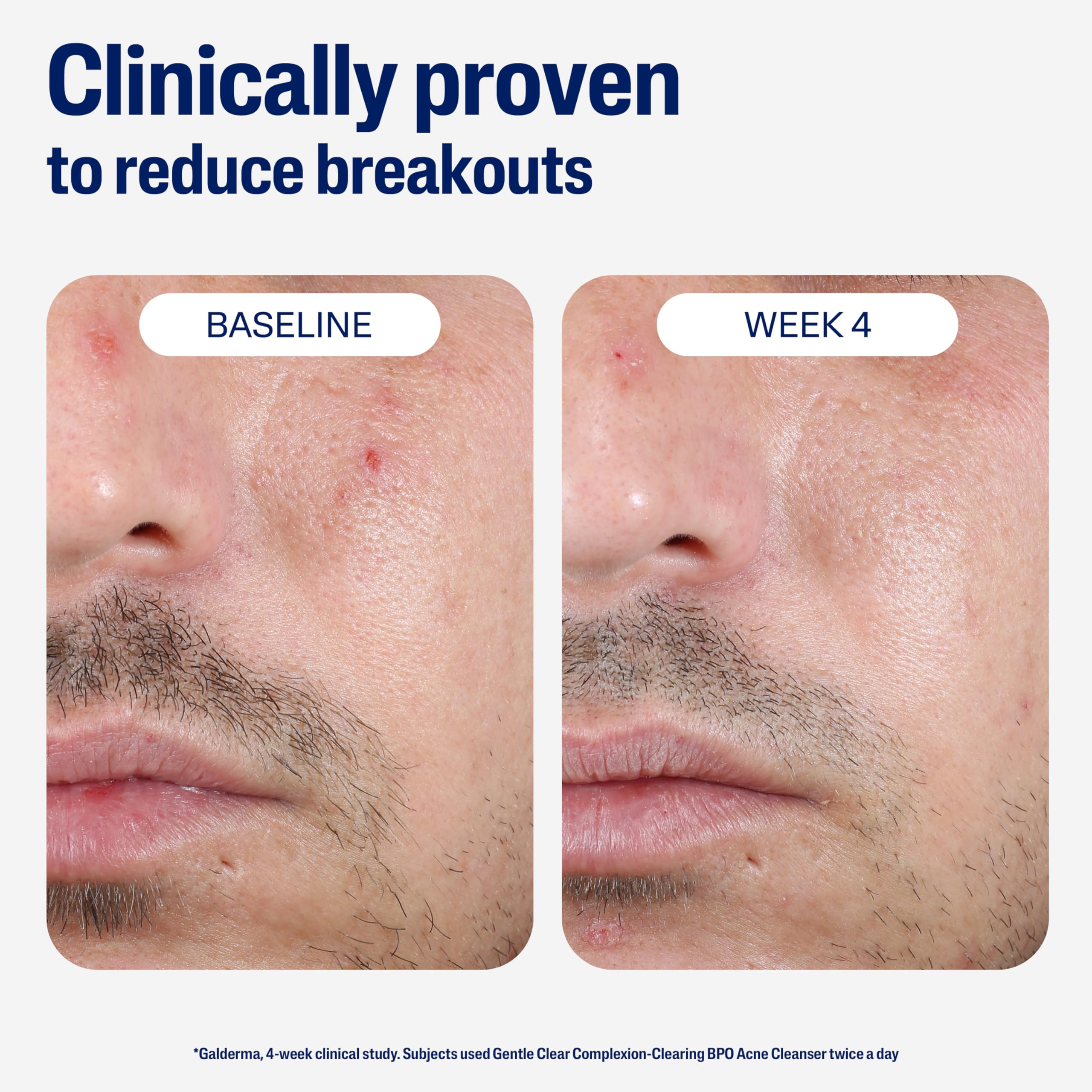 cetaphil-gentle-clear-complexion-clearing-bpo-acne-cleanser-2-6-benzoyl-peroxide image 6