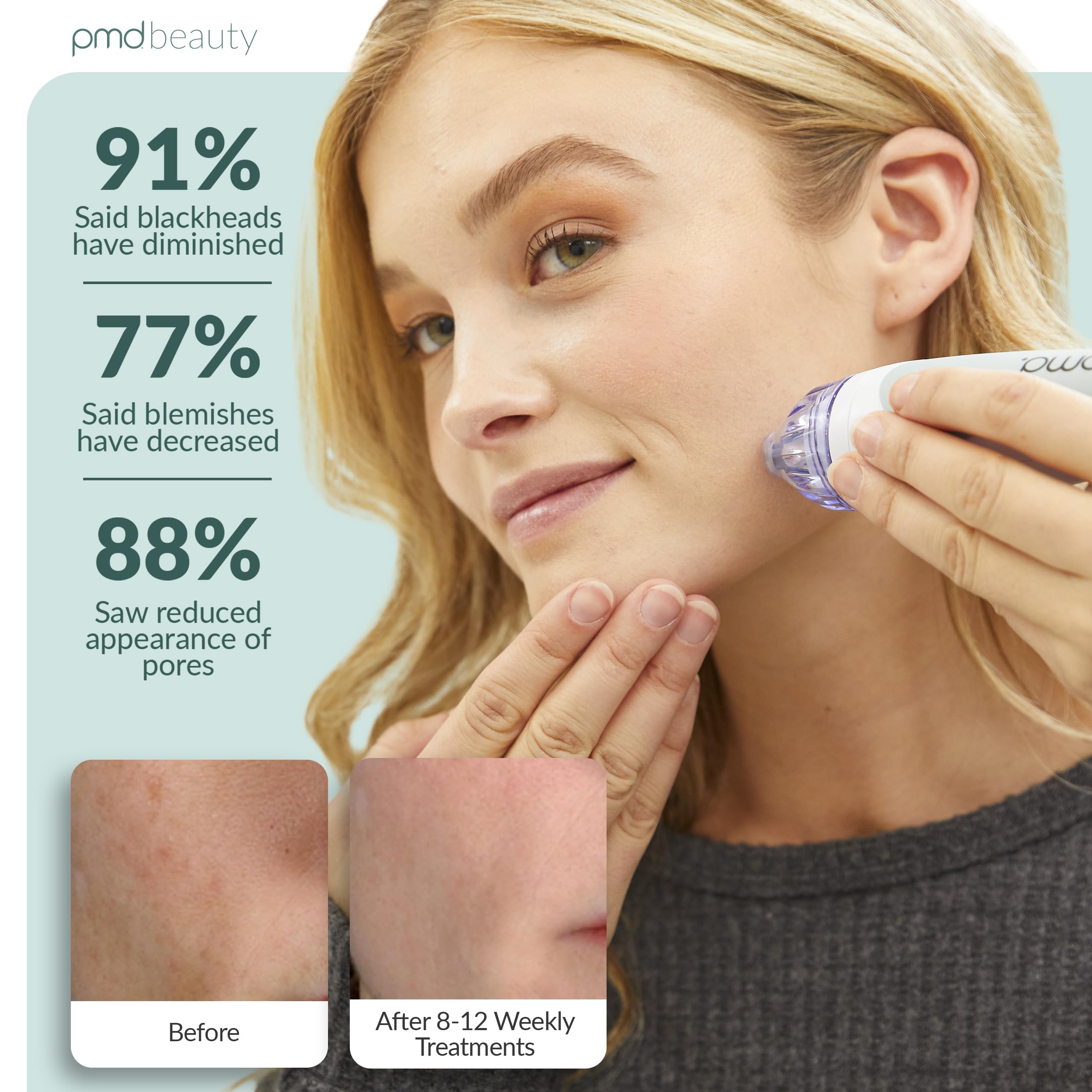 pmd-beauty-personal-microderm-classic-at-home-microdermabrasion-device-for-face- image 3