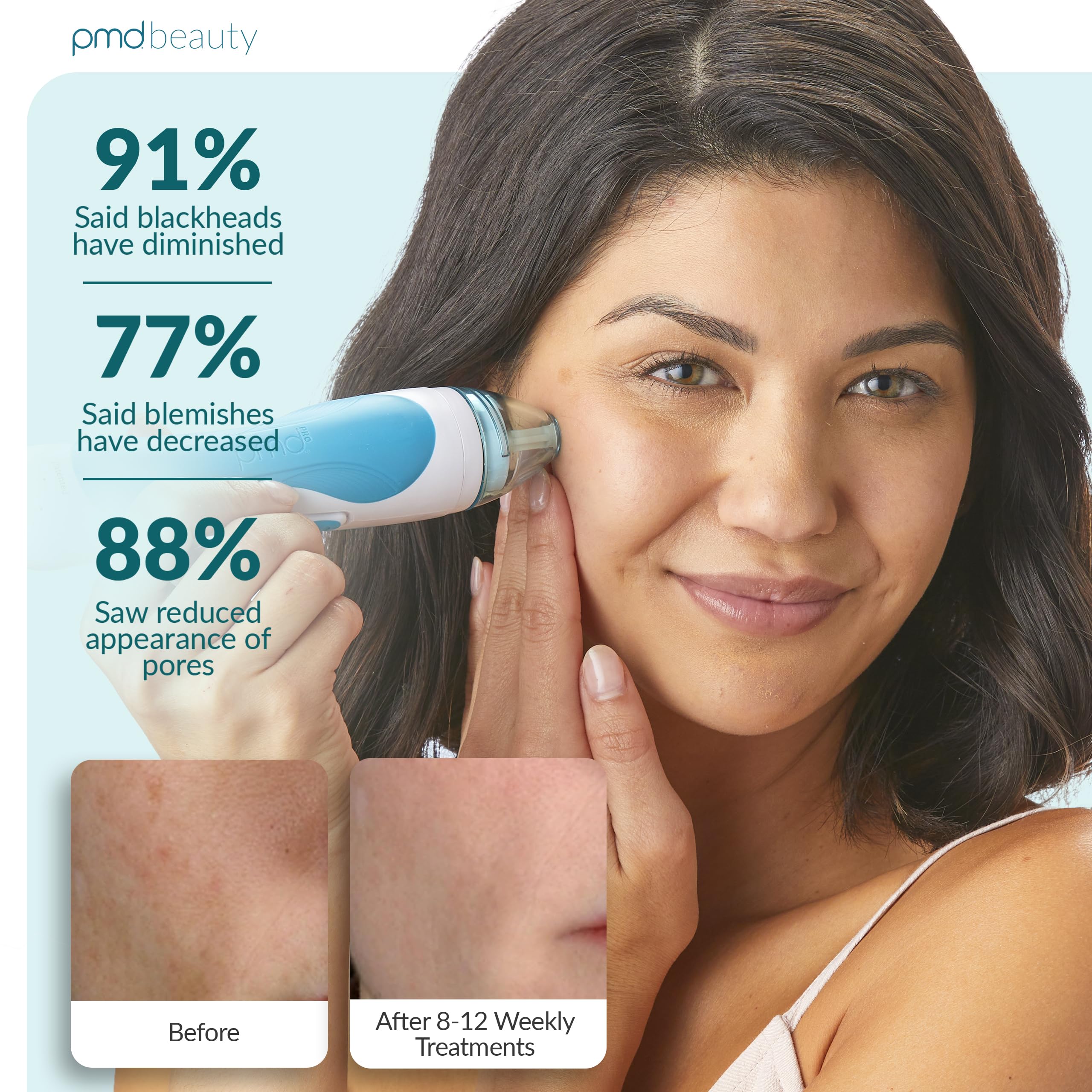pmd-personal-microderm-pro-at-home-microdermabrasion-machine-with-exfoliating-cr image 4