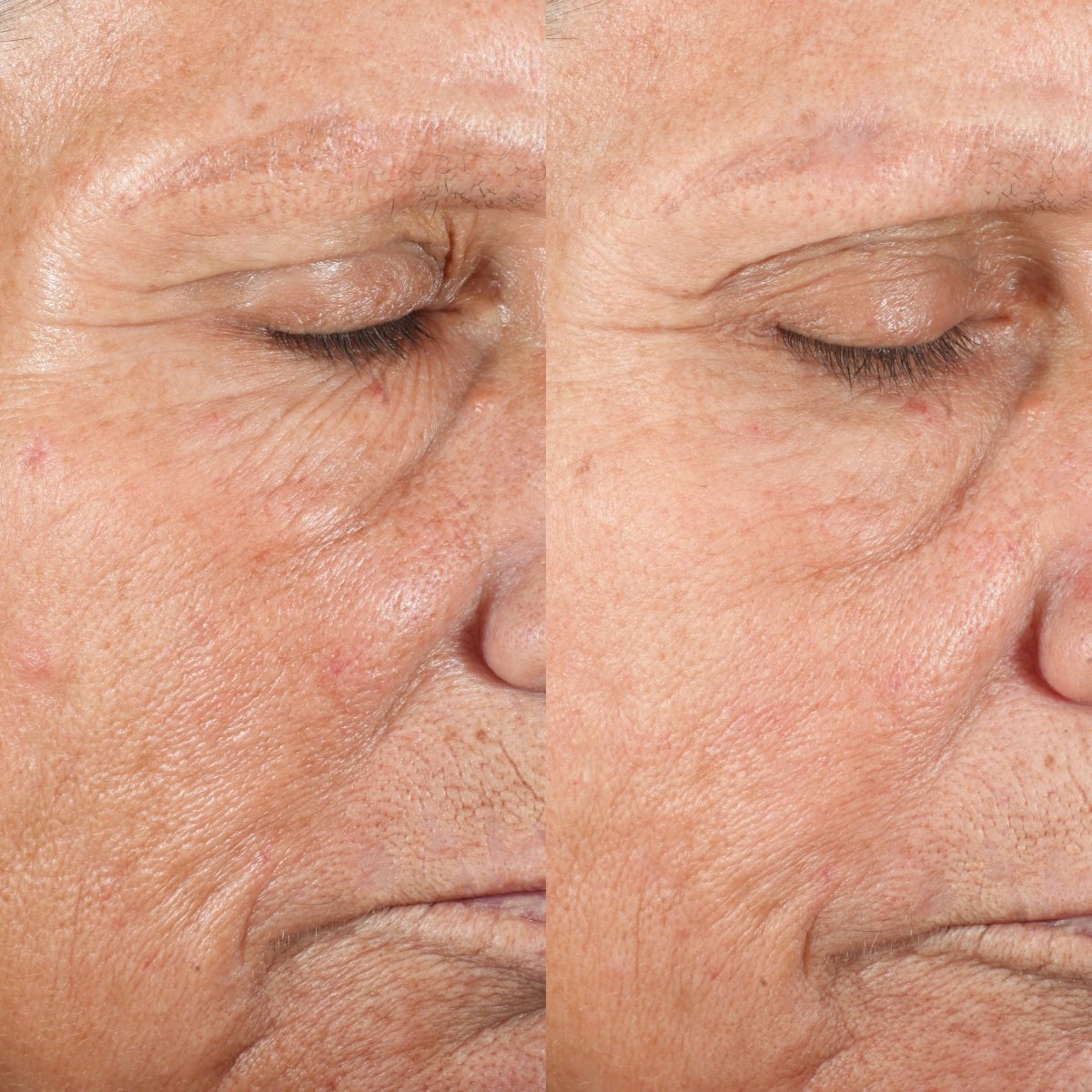 pmd-personal-microderm-elite-pro-advanced-home-microdermabrasion-device-with-tri image 2