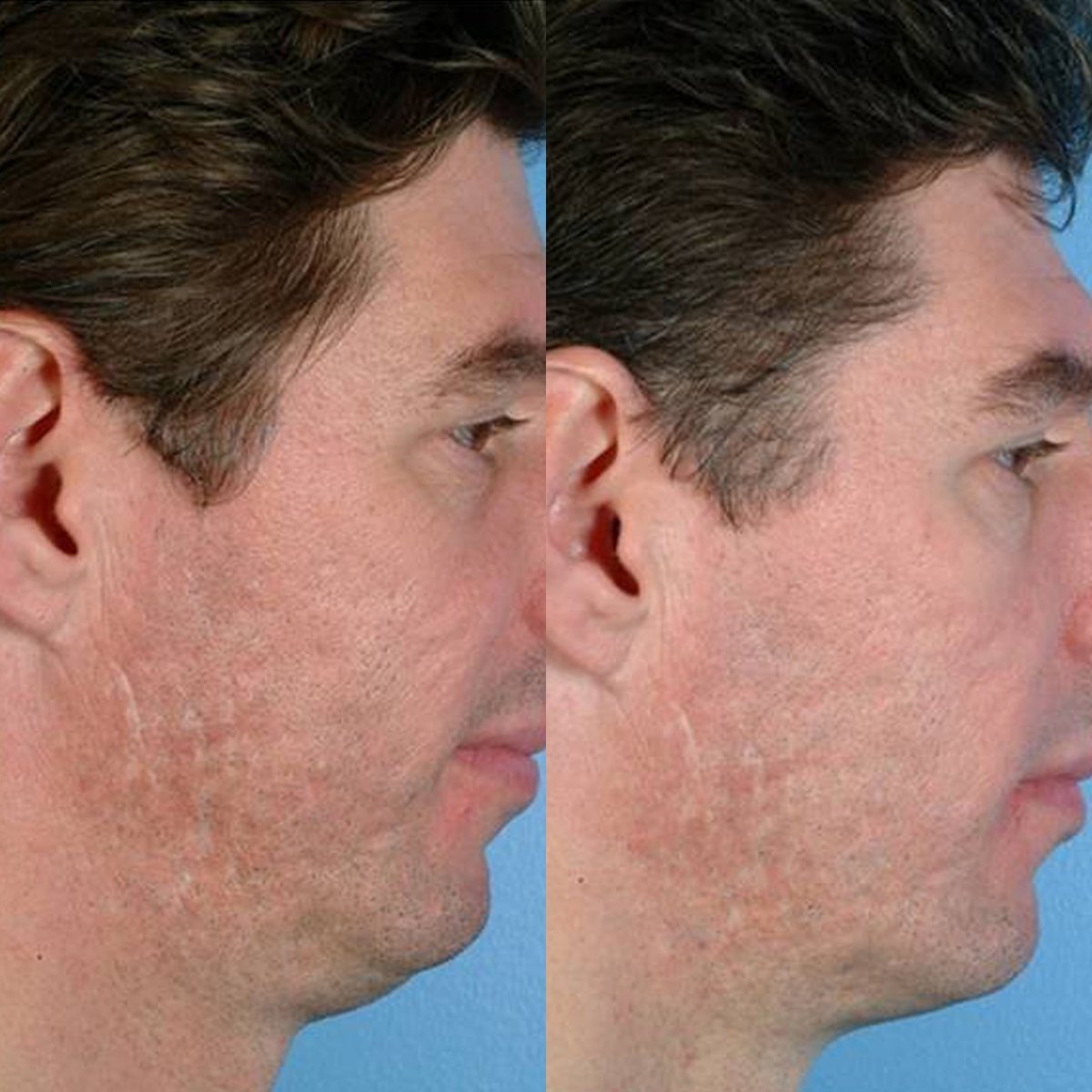 pmd-beauty-personal-microderm-man image 3