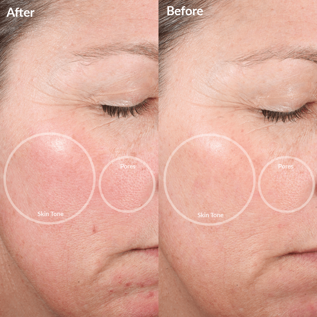 pmd-beauty-personal-microderm-elite-pro-advanced-microdermabrasion-device-with-2 image 4