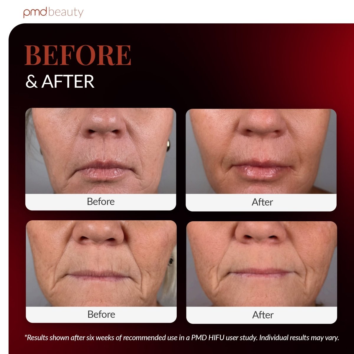 pmd-beauty-hifu-non-invasive-skin-tightening-device-korean-hifu-tech image 5